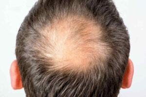 Leia mais sobre o artigo Pesquisa elege melhores tratamentos contra queda de cabelos do homem
