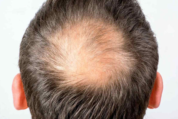Você está visualizando atualmente Pesquisa elege melhores tratamentos contra queda de cabelos do homem