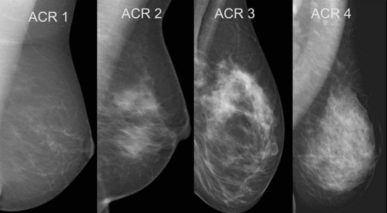 exame-de-tomossintese-e-eficaz-para-detectar-cancer-de-mama