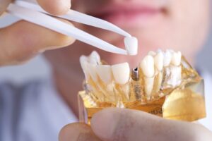 Leia mais sobre o artigo Os 5 principais mitos e verdades sobre implante dentário