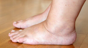 Leia mais sobre o artigo Conheça 3 sinais nos pés que indicam problemas no fígado
