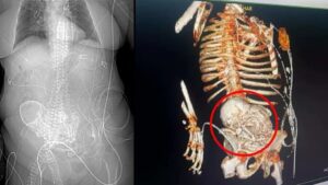 Leia mais sobre o artigo BEBÊ DE PEDRA: Idosa descobre feto calcificado e morre após cirurgia em MS