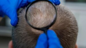 Leia mais sobre o artigo Novo soro capilar promete resultados inéditos contra a calvície