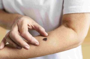 Leia mais sobre o artigo Na luta contra o câncer de pele, campanha oferece check-up gratuito em municípios de MS