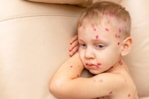 Leia mais sobre o artigo Casos de sarampo disparam nos EUA e geram alerta internacional