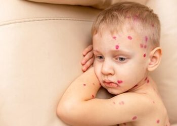 casos-de-sarampo-disparam-nos-eua-e-geram-alerta-internacional